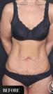 Tummy Tuck - Dr. Salih Onur Basat Clinic