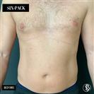 Six-Pack - Dr. Salih Onur Basat Clinic