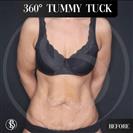 Tummy Tuck - Dr. Salih Onur Basat Clinic