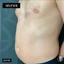 Six-Pack - Dr. Salih Onur Basat Clinic
