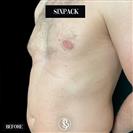 Six-Pack - Dr. Salih Onur Basat Clinic