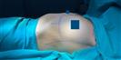 Breast Augmentation - ADATIP Hospital