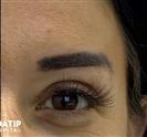 Eyelid Surgery - ADATIP Hospital