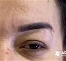 Eyelid Surgery - ADATIP Hospital