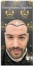 FUE Hair Transplant - ADATIP Hospital