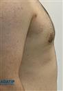 Gynecomastia Surgery - ADATIP Hospital