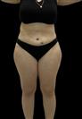 Tummy Tuck - ADATIP Hospital