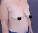 Breast Augmentation with Round Implants - TWT Health Tourism