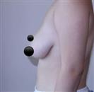 Breast Augmentation with Round Implants - TWT Health Tourism