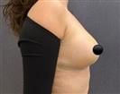 Breast Lift - Mastopexy - TWT Health Tourism