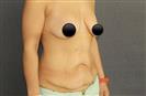 Breast Lift - Mastopexy - TWT Health Tourism