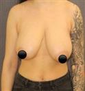 Breast Lift - Mastopexy - TWT Health Tourism
