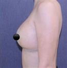 Breast Reduction - TWT Health Tourism
