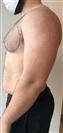 Gynocomastia with Liposuction - TWT Health Tourism
