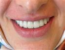 Porcelain Veneers - TWT Health Tourism