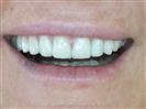 Porcelain Veneers - TWT Health Tourism