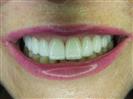Porcelain Veneers - TWT Health Tourism