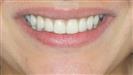 Porcelain Veneers - TWT Health Tourism