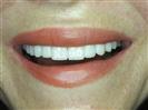 Porcelain Veneers - TWT Health Tourism