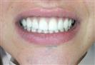 Porcelain Veneers - TWT Health Tourism