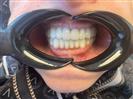 Porcelain Veneers - TWT Health Tourism