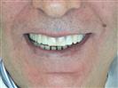 Porcelain Veneers - TWT Health Tourism