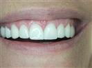 Porcelain Veneers - TWT Health Tourism