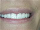 Porcelain Veneers - TWT Health Tourism