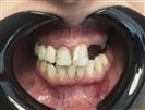 Porcelain Veneers - TWT Health Tourism