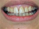 Porcelain Veneers - TWT Health Tourism