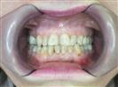 Porcelain Veneers - TWT Health Tourism