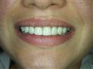 Porcelain Veneers - TWT Health Tourism