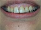 Porcelain Veneers - TWT Health Tourism