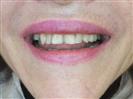 Porcelain Veneers - TWT Health Tourism