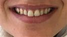 Porcelain Veneers - TWT Health Tourism