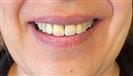 Porcelain Veneers - TWT Health Tourism