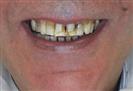 Porcelain Veneers - TWT Health Tourism