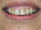 Porcelain Veneers - TWT Health Tourism
