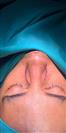 Rhinoplasty - TWT Health Tourism