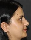 Rhinoplasty - TWT Health Tourism