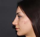 Rhinoplasty - TWT Health Tourism