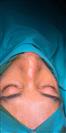 Rhinoplasty - TWT Health Tourism