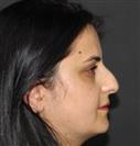 Rhinoplasty - TWT Health Tourism