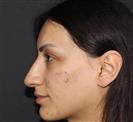 Rhinoplasty - TWT Health Tourism