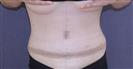 Tummy Tuck - TWT Health Tourism