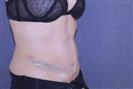 Tummy Tuck - TWT Health Tourism