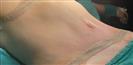 Tummy Tuck - TWT Health Tourism