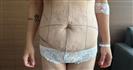 Tummy Tuck - TWT Health Tourism
