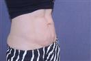 Tummy Tuck - TWT Health Tourism