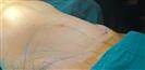 Tummy Tuck - TWT Health Tourism
